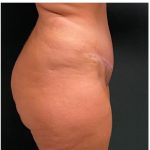 Abdominoplasty Before & After Patient #15911