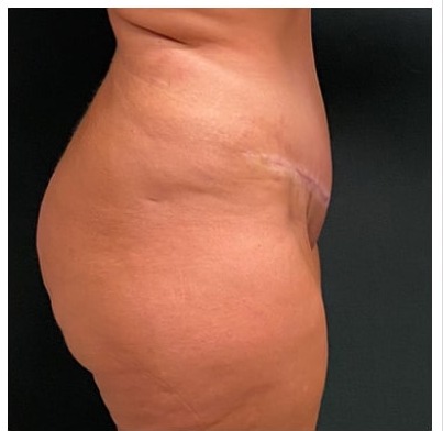 Abdominoplasty Before & After Patient #15911