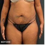 Abdominoplasty Before & After Patient #15912