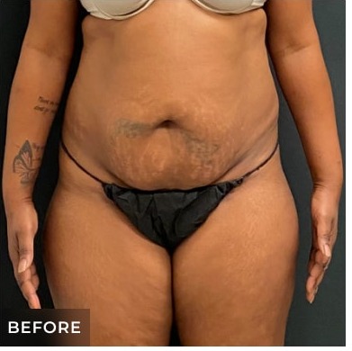 Abdominoplasty Before & After Patient #15912