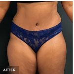 Abdominoplasty Before & After Patient #15912