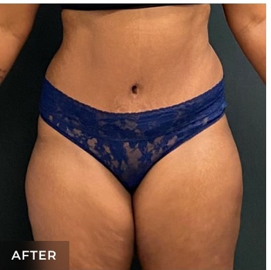 Abdominoplasty Before & After Patient #15912