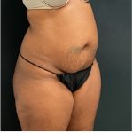 Abdominoplasty Before & After Patient #15912
