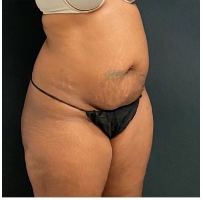 Abdominoplasty Before & After Patient #15912