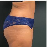 Abdominoplasty Before & After Patient #15912