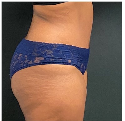 Abdominoplasty Before & After Patient #15912