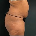 Abdominoplasty Before & After Patient #15912