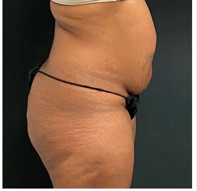 Abdominoplasty Before & After Patient #15912