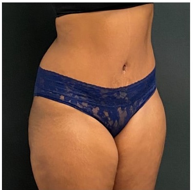 Abdominoplasty Before & After Patient #15912
