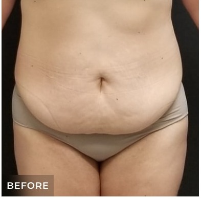 Massive Weight Loss Before & After Patient #15955