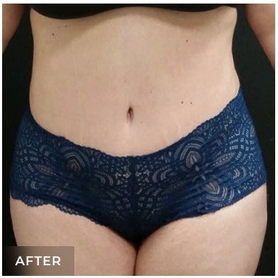 Massive Weight Loss Before & After Patient #15955
