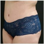 Massive Weight Loss Before & After Patient #15955