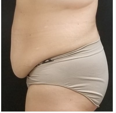 Massive Weight Loss Before & After Patient #15955