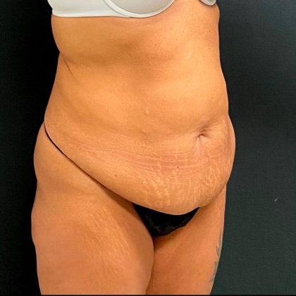 Massive Weight Loss Before & After Patient #15964