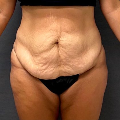 Massive Weight Loss Before & After Patient #15966