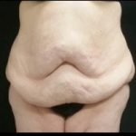 Massive Weight Loss Before & After Patient #15956