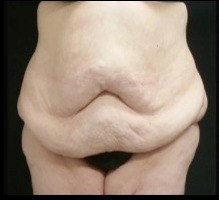 Massive Weight Loss Before & After Patient #15956