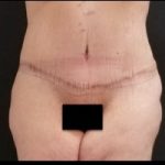 Massive Weight Loss Before & After Patient #15956