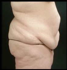 Massive Weight Loss Before & After Patient #15956