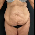 Massive Weight Loss Before & After Patient #15957