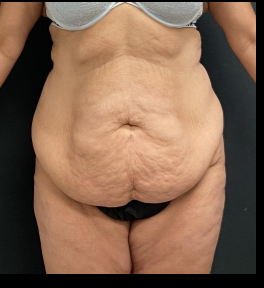 Massive Weight Loss Before & After Patient #15957