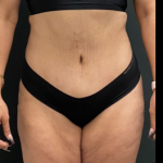 Massive Weight Loss Before & After Patient #15957