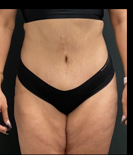 Massive Weight Loss Before & After Patient #15957