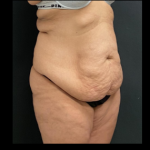 Massive Weight Loss Before & After Patient #15957