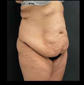 Massive Weight Loss Before & After Patient #15957
