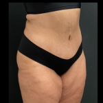 Massive Weight Loss Before & After Patient #15957
