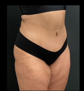 Massive Weight Loss Before & After Patient #15957