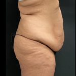 Massive Weight Loss Before & After Patient #15957