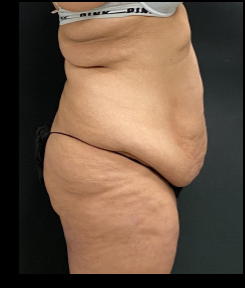 Massive Weight Loss Before & After Patient #15957