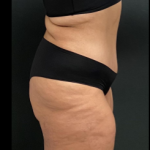 Massive Weight Loss Before & After Patient #15957