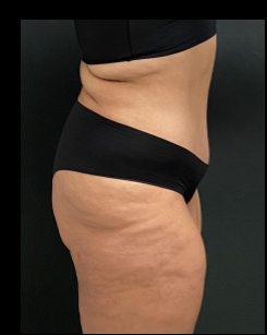 Massive Weight Loss Before & After Patient #15957