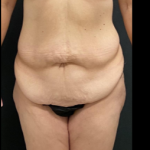 Massive Weight Loss Before & After Patient #15958