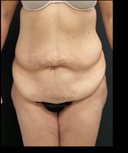 Massive Weight Loss Before & After Patient #15958