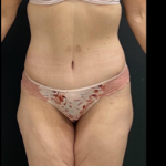 Massive Weight Loss Before & After Patient #15958