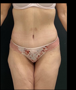 Massive Weight Loss Before & After Patient #15958