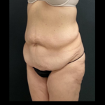 Massive Weight Loss Before & After Patient #15958