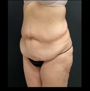 Massive Weight Loss Before & After Patient #15958