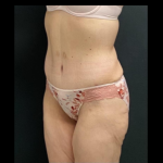 Massive Weight Loss Before & After Patient #15958