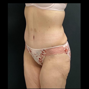Massive Weight Loss Before & After Patient #15958