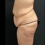 Massive Weight Loss Before & After Patient #15958