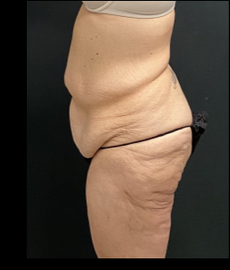 Massive Weight Loss Before & After Patient #15958