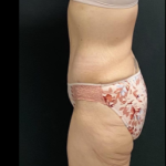 Massive Weight Loss Before & After Patient #15958