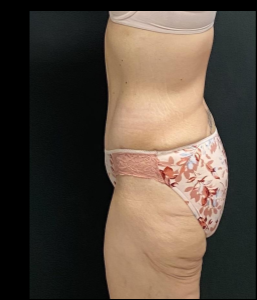 Massive Weight Loss Before & After Patient #15958