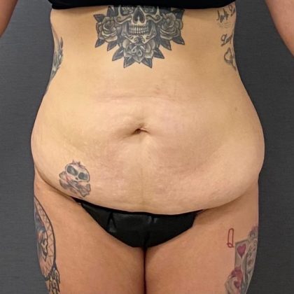 Massive Weight Loss Before & After Patient #15959