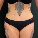 Massive Weight Loss Before & After Patient #15959