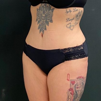 Massive Weight Loss Before & After Patient #15959
